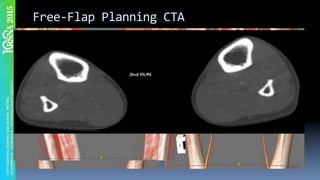 Free-Flap	Planning	CTA	
 