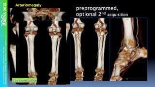 preprogrammed,
optional 2nd acquisition
Arteriomegaly
1st acquisition
 