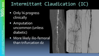 Intermittant	Claudication	(IC)	
§  Only	¼	progress	
clinically	
§  Amputation	
uncommon	(unless	
diabetic)	
§  More	likely	ilio-femoral	
than	trifurcation	dz	
 