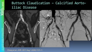 Buttock	Claudication	–	Calcified	Aorto-
iliac	Disease	
Chang et al. JVIR. 2011 Aug 1;22(8):1131–1.
 