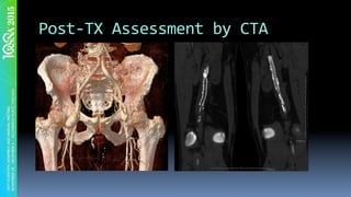 Post-TX	Assessment	by	CTA	
 