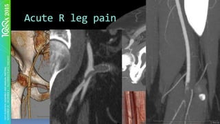 Acute	R	leg	pain	
 