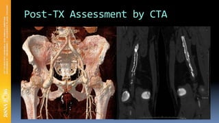 Peripheral CTA Imaging | PDF