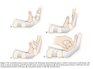 Hand Physiotherapy-RehabilitationAGP.pptx