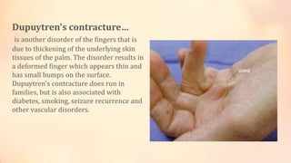 Dupuytren's contracture… 
is another disorder of the fingers that is 
due to thickening of the underlying skin 
tissues of the palm. The disorder results in 
a deformed finger which appears thin and 
has small bumps on the surface. 
Dupuytren's contracture does run in 
families, but is also associated with 
diabetes, smoking, seizure recurrence and 
other vascular disorders. 
 