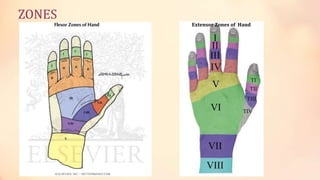 ZONES 
Extensor Zones of Hand 
 