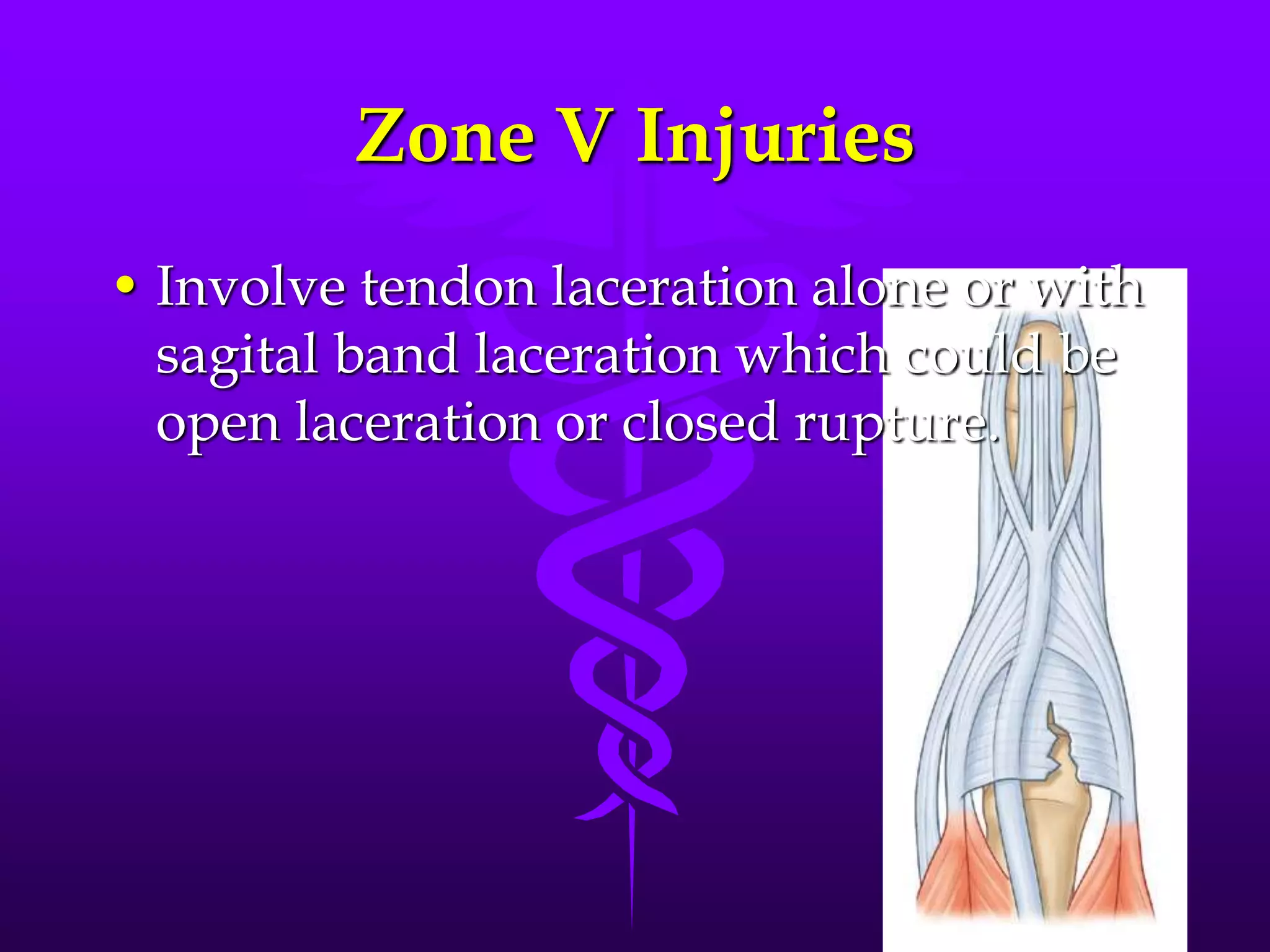 Zone V Injuries
• Involve tendon laceration alone or with
sagital band laceration which could be
open laceration or closed rupture.
 