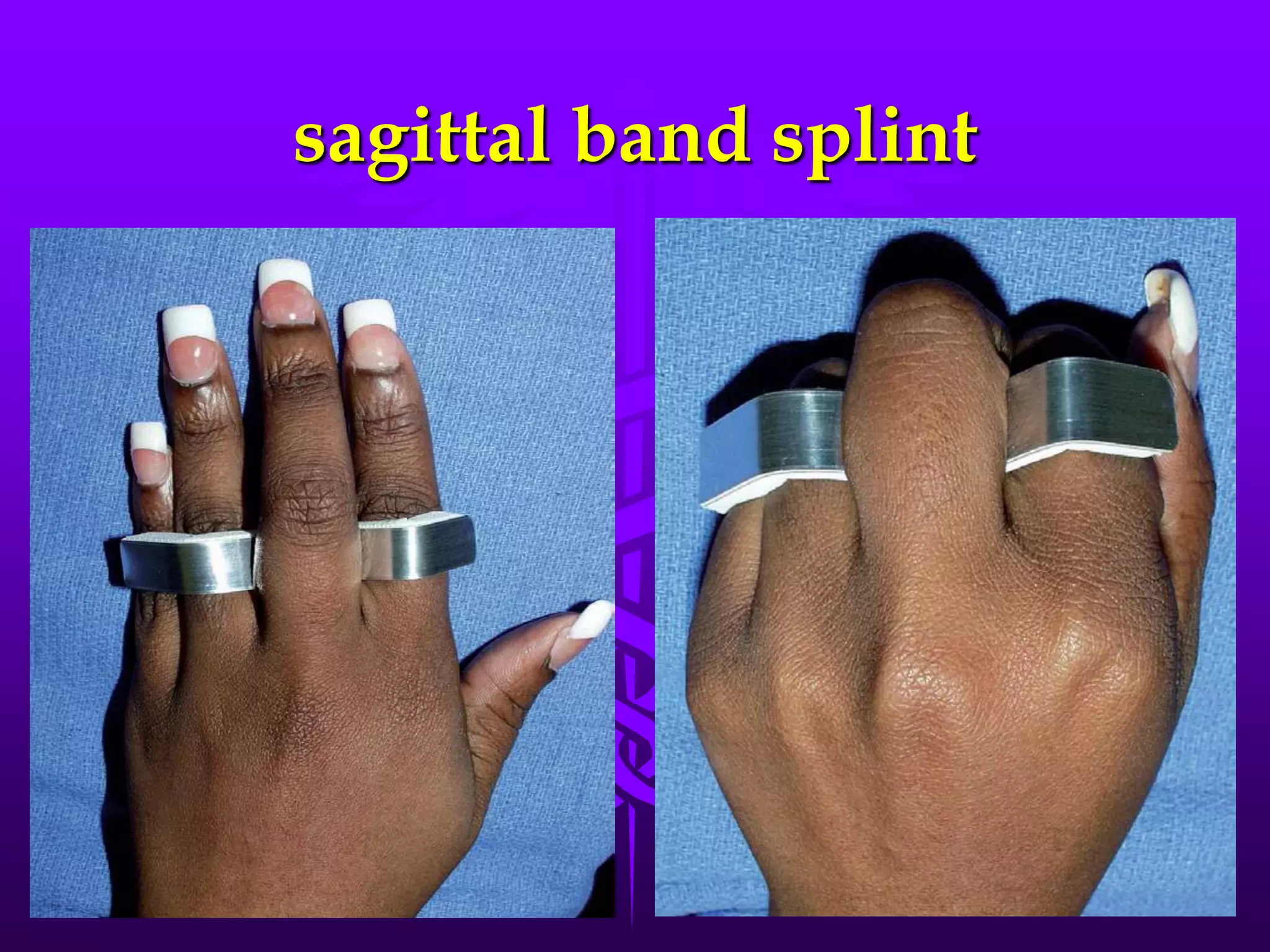 sagittal band splint
 