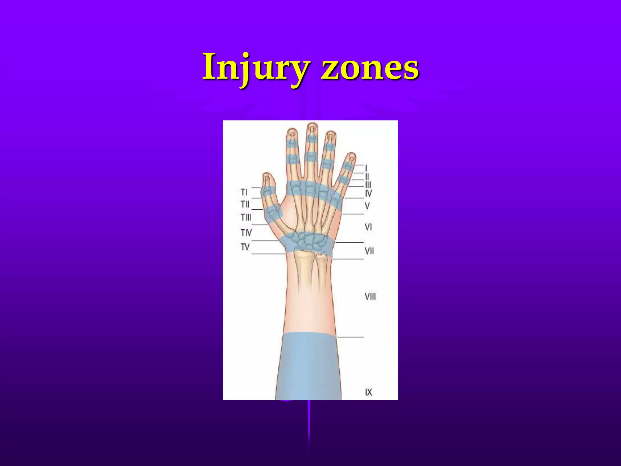Injury zones
 