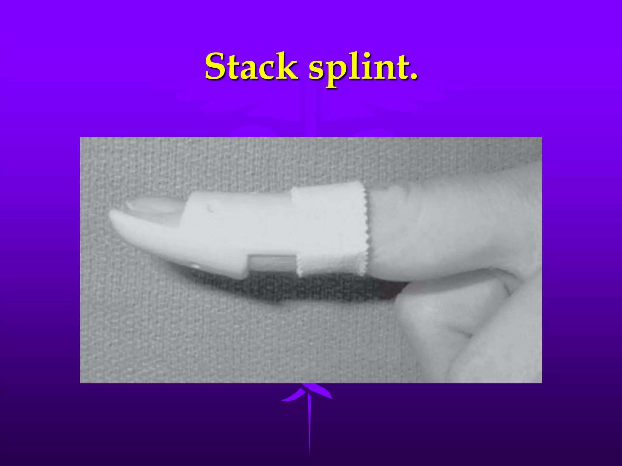 Stack splint.
 