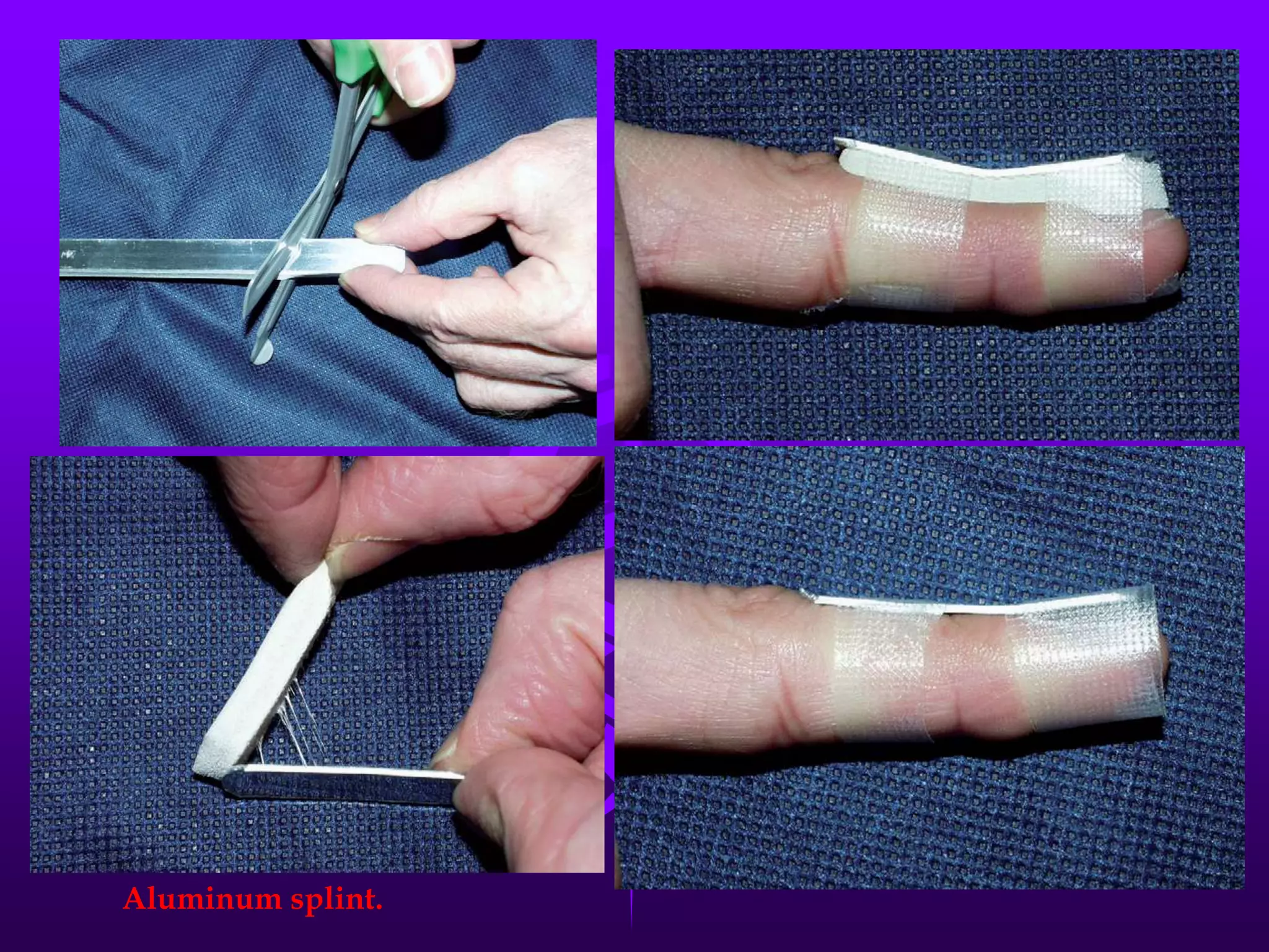 Aluminum splint.
 