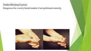 Hand Rehabilitation Following Flexor Tendon Injuries | PPT