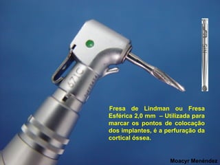 Fresa de Lindman ou Fresa
Esférica 2,0 mm – Utilizada para
marcar os pontos de colocação
dos implantes, é a perfuração da
cortical óssea.

Moacyr Menéndez

 