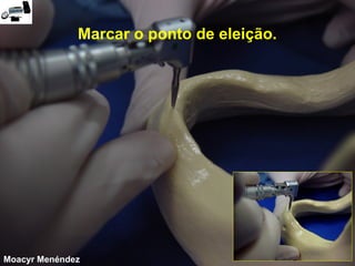 Marcar o ponto de eleição.

Moacyr Menéndez

 