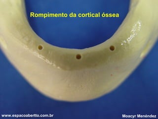 Rompimento da cortical óssea

www.espacoabertto.com.br

Moacyr Menéndez

 