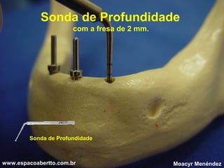 Sonda de Profundidade
com a fresa de 2 mm.

Sonda de Profundidade

www.espacoabertto.com.br

Moacyr Menéndez

 