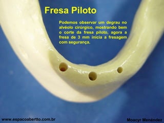 Fresa Piloto
Podemos observar um degrau no
alvéolo cirúrgico, mostrando bem
o corte da fresa piloto, agora a
fresa de 3 mm inicia a fresagem
com segurança.

www.espacoabertto.com.br

Moacyr Menéndez

 
