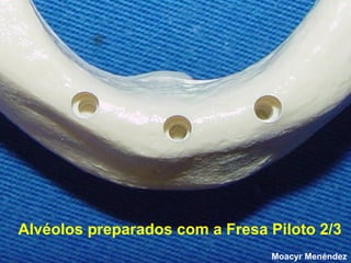 Alvéolos preparados com a Fresa Piloto 2/3 .
Moacyr Menéndez

 