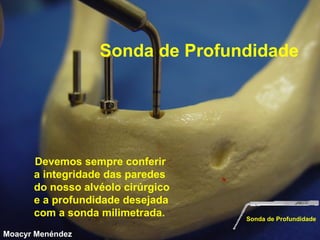 Sonda de Profundidade

Devemos sempre conferir
a integridade das paredes
do nosso alvéolo cirúrgico
e a profundidade desejada
com a sonda milimetrada.
Moacyr Menéndez

Sonda de Profundidade

 