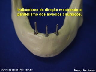 Indicadores de direção mostrando o
paralelismo dos alvéolos cirúrgicos.

www.espacoabertto.com.br

Moacyr Menéndez

 