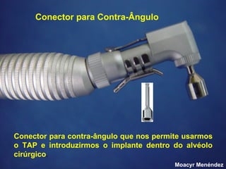 Conector para Contra-Ângulo

Conector para contra-ângulo que nos permite usarmos
o TAP e introduzirmos o implante dentro do alvéolo
cirúrgico.
Moacyr Menéndez

 