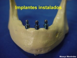 Implantes instalados

Moacyr Menéndez

 