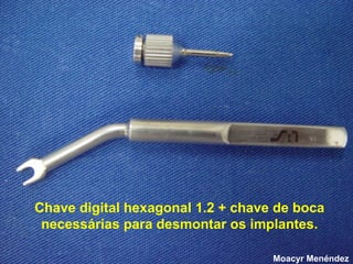 Chave digital hexagonal 1.2 + chave de boca
necessárias para desmontar os implantes.
Moacyr Menéndez

 