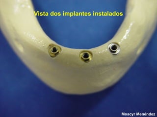 Vista dos implantes instalados

Moacyr Menéndez

 