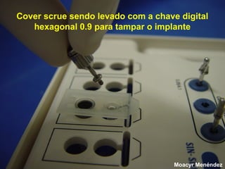 Cover scrue sendo levado com a chave digital
hexagonal 0.9 para tampar o implante

Moacyr Menéndez

 