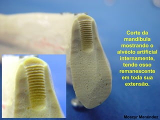 Corte da
mandíbula
mostrando o
alvéolo artificial
internamente,
tendo osso
remanescente
em toda sua
extensão.

Moacyr Menéndez

 