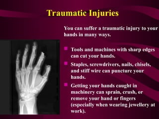 Hand Safety Injuries Hand health & safety campaign presentation | PPT