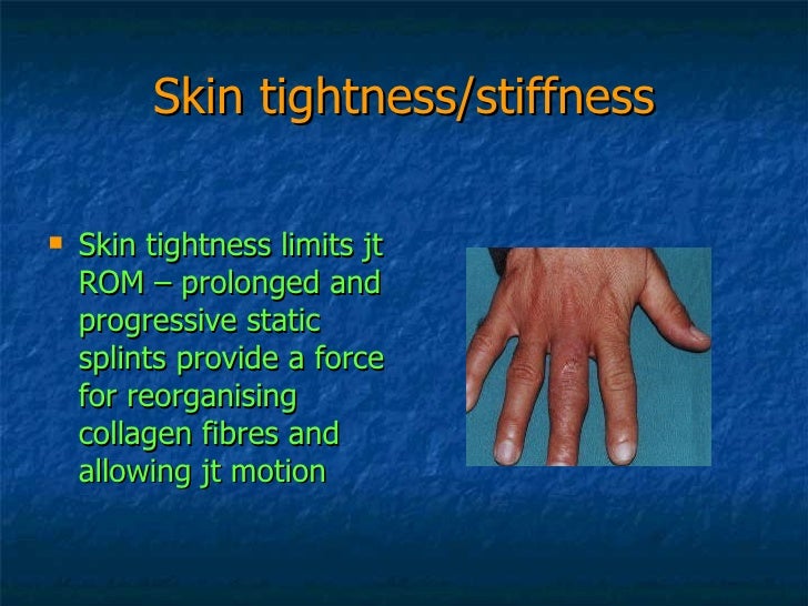 Hand Therapy Stiff Small Joints Of The Fingers