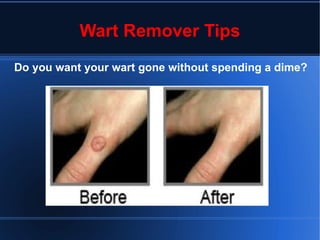Wart Remover Tips Do you want your wart gone without spending a dime?   