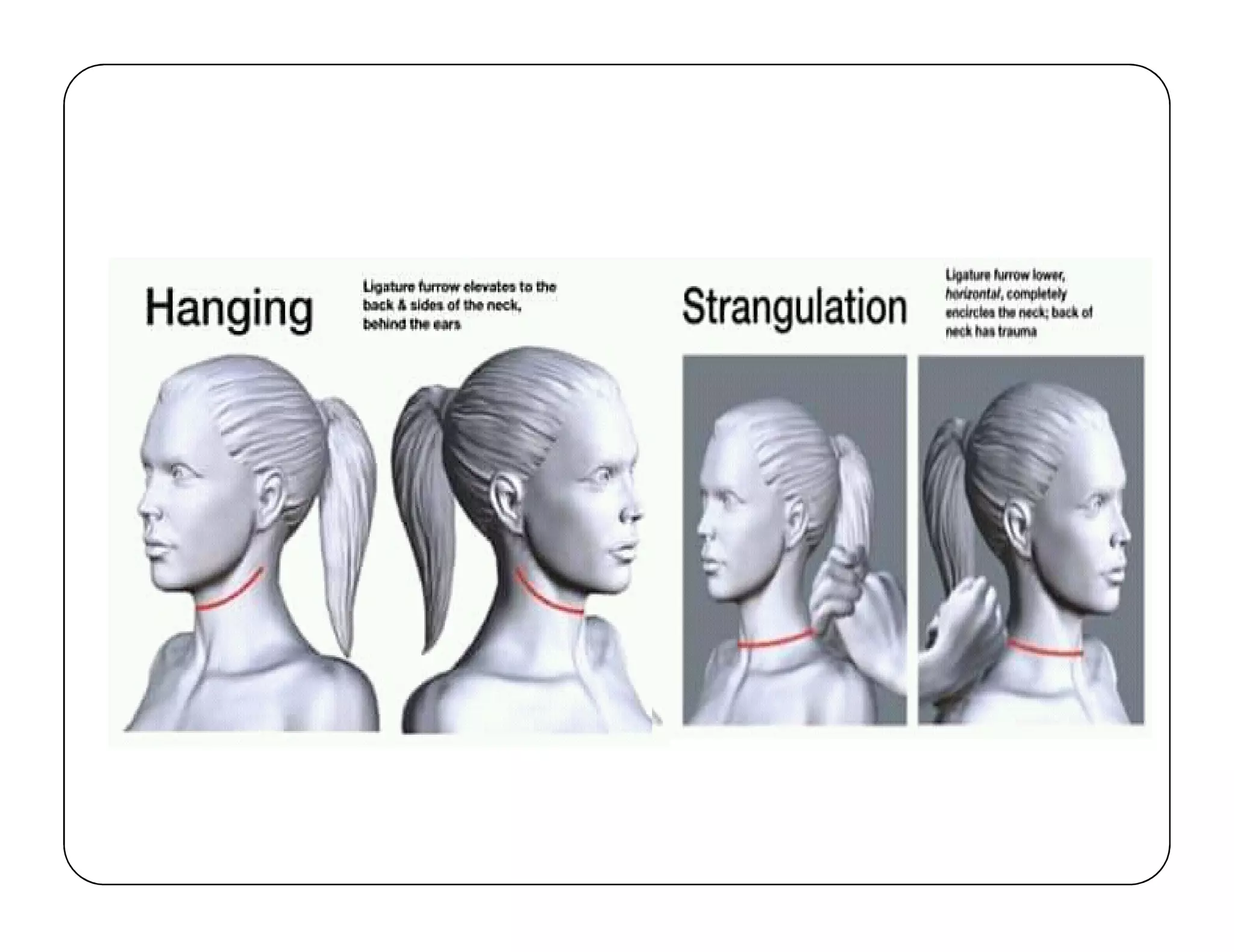 Hanging, strangulation, Asphyxial death | PDF