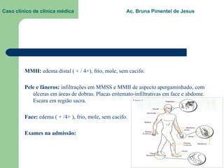 Caso clínico de clínica médica  Ac. Bruna Pimentel de Jesus MMII:  edema distal ( + / 4+), frio, mole, sem cacifo. Pele e fâneros:  infiltrações em MMSS e MMII de aspecto apergaminhado, com úlceras em áreas de dobras. Placas eritemato-infiltrativas em face e abdome. Escara em região sacra. Face:  edema ( + /4+ ), frio, mole, sem cacifo. Exames na admissão: 