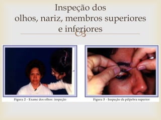 Inspeção dos
olhos, nariz, membros superiores
           e inferiores
              
 