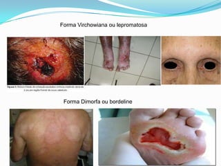 Forma Virchowiana ou lepromatosa
Forma Dimorfa ou bordeline
 