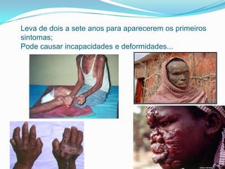 Leva de dois a sete anos para aparecerem os primeiros
sintomas;
Pode causar incapacidades e deformidades...
 