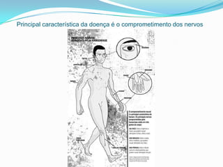 Principal característica da doença é o comprometimento dos nervos
 