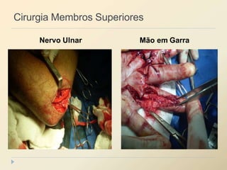 Cirurgia Membros Superiores
Nervo Ulnar Mão em Garra
 