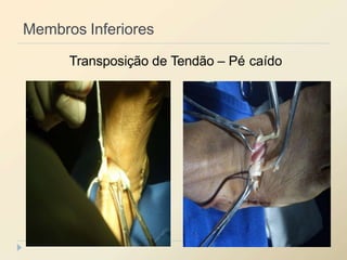 Membros Inferiores
Transposição de Tendão – Pé caído
 