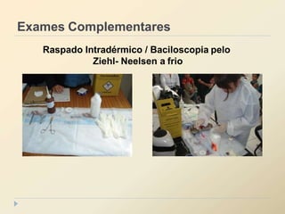 Exames Complementares
Raspado Intradérmico / Baciloscopia pelo
Ziehl- Neelsen a frio
 