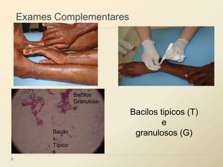 Exames Complementares
Bacilos tipicos (T)
e
granulosos (G)
Bacilo
s
Típico
s
Bacilos
Granuloso
s
 