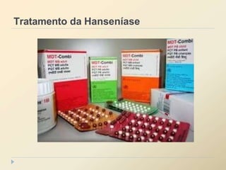 Tratamento da Hanseníase
 