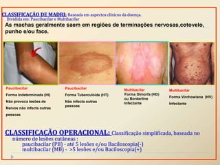 CLASSIFICAÇÃO DE MADRI: Baseada em aspectos clínicos da doença.
Dividida em: Paucibacilar e Multibacilar
Paucibacilar
Forma Indeterminada (HI)
Não provoca lesões de
Nervos não infecta outras
pessoas
Paucibacilar
Forma Tuberculóide (HT)
Não infecta outras
pessoas
Multibacilar
Forma Dimorfa (HD)
ou Borderline
Infectante
Multibacilar
Forma Virchowiana (HV)
Infectante
CLASSIFICAÇÃO OPERACIONAL: Classificação simplificada, baseada no
número de lesões cutâneas :
paucibacilar (PB) - até 5 lesões e/ou Baciloscopia(-)
multibacilar (MB) - >5 lesões e/ou Baciloscopia(+)
As machas geralmente saem em regiões de terminações nervosas,cotovelo,
punho e/ou face.
 