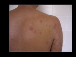 Simpósio Hanseníase - Hanseníase - dermatologista Carla