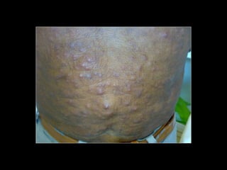 Simpósio Hanseníase - Hanseníase - dermatologista Carla