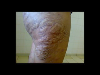 Simpósio Hanseníase - Hanseníase - dermatologista Carla