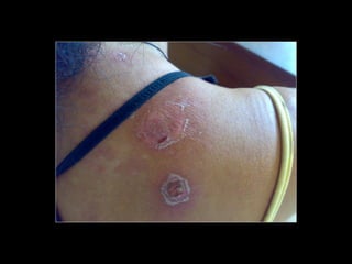 Simpósio Hanseníase - Hanseníase - dermatologista Carla