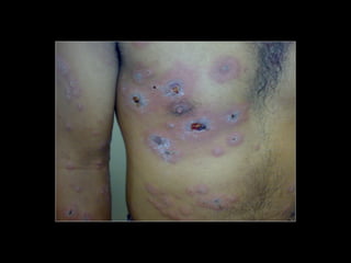 Simpósio Hanseníase - Hanseníase - dermatologista Carla